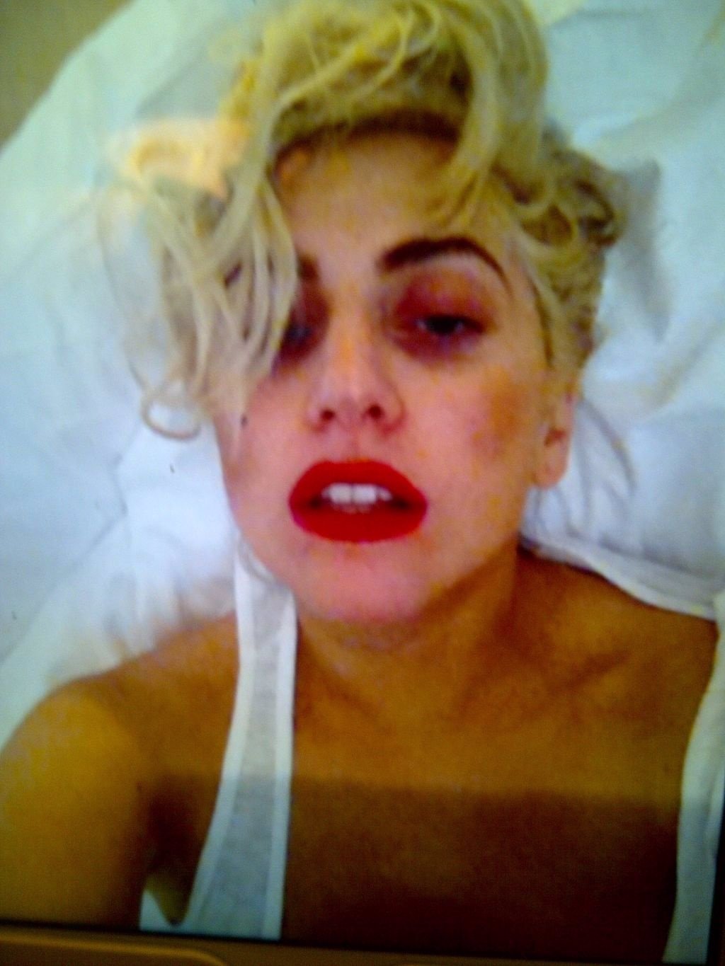Lady Gaga después de sufrir una conmoción cerebral 