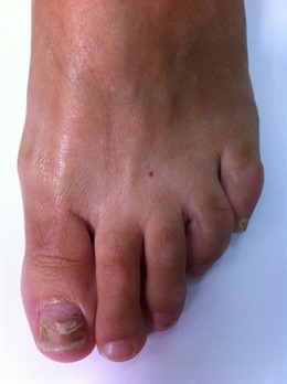 Pie Afectado Por Hongos