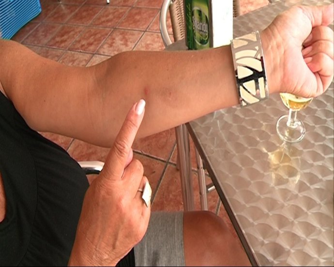 Una Clienta De Una Terraza De Cullera Muestra Una Picadura De Mosquito.