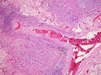 Los antirretrovirales reducen el riesgo de infección por tuberculosis en las personas con VIH 