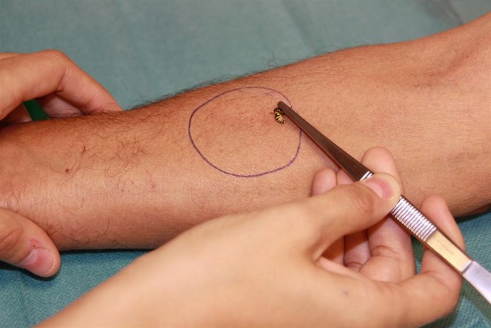 Alergia, alérgico, picadura, mosquito, avispa