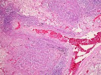 Altas dosis de vitamina D ayudan a pacientes con tuberculosis a recuperarse con más rapidez