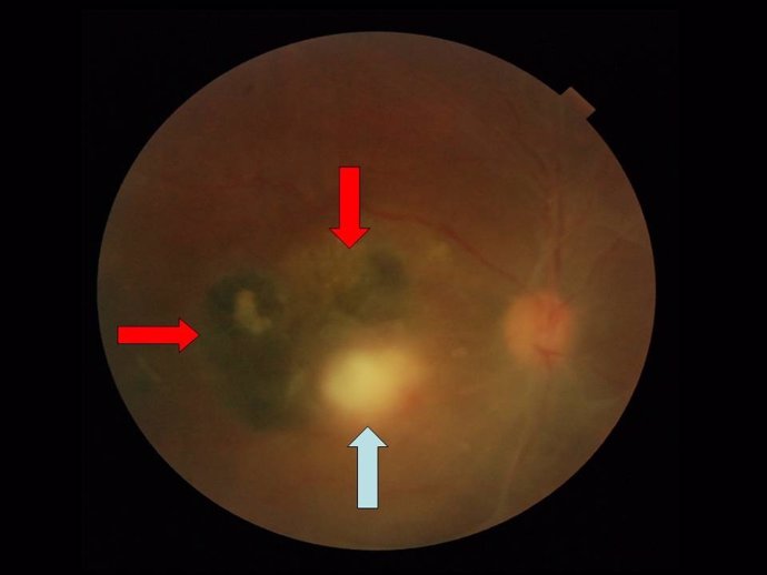 Lesión Ocular Por Toxoplasmosis
