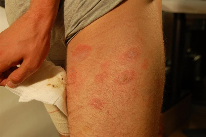 Algunas de las quemaduras que presentaba la víctima