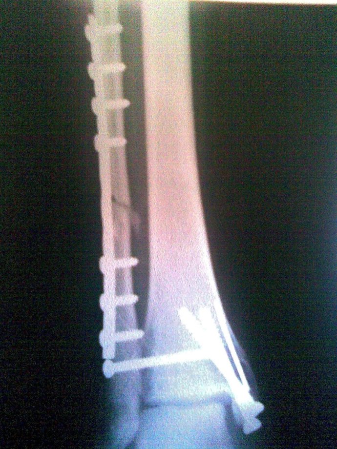 Radiografia, Hueso