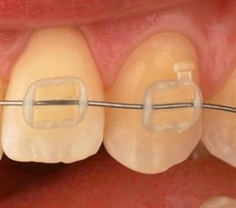 Nueva generación de brackets