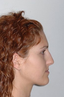 Imagen de perfil de una paciente de cirugía facial