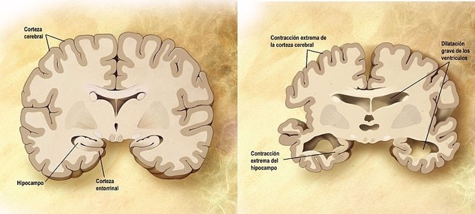 Corte frontal del cerebro
