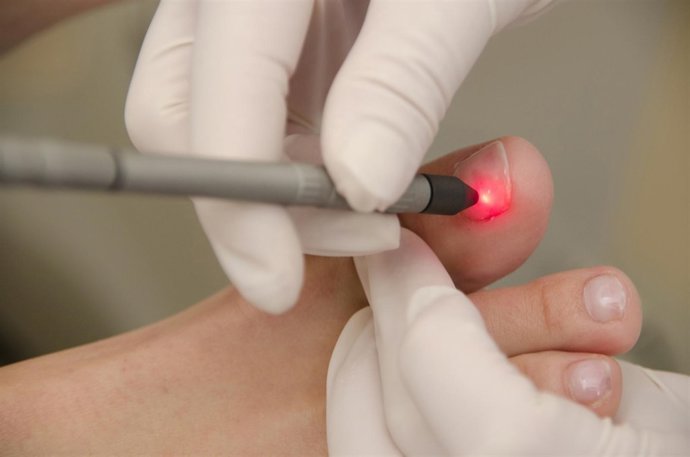 Método láser contra los hongos de las uñas