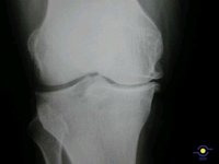 El coste medio de la artrosis de rodilla y de cadera en España supera los 4.700 millones al año