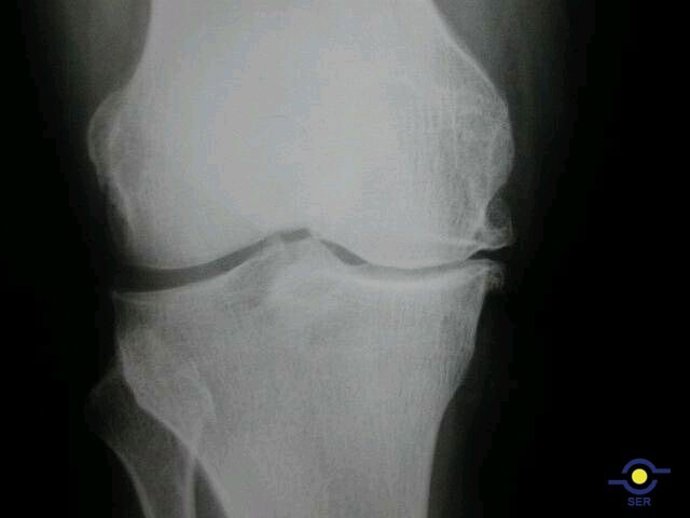 Sociedad Española de Reumatología -artrosis