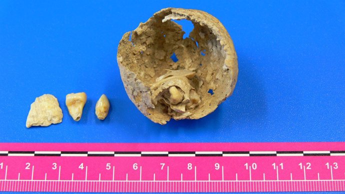 Tumor de una mujer de la época romana (investigación UAB)