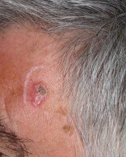 La incidencia del cáncer de piel no melanoma es el doble en los pacientes  con VIH