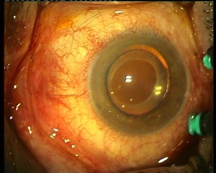 Imágen de un ojo con una enfermedad retiniana