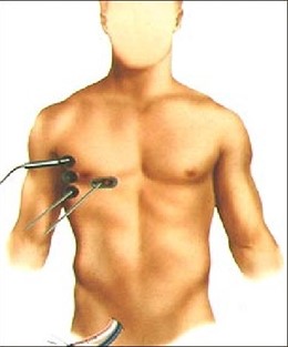 Cirugia cardiaca mininvasiva