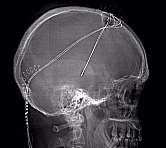 Tratamiento Parkinson 