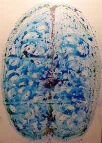 Los cerebros de las personas con Alzheimer tienen un 83% menos de comunicación entre las neuronas