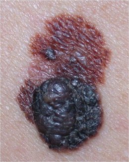 Peca con melanoma