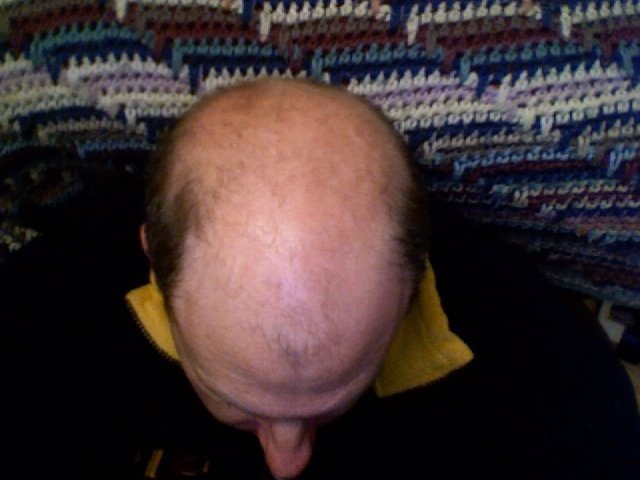 calvicie, calvo, alopecia