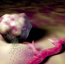 Cancer de cervix avanzado