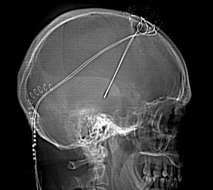 Tratamiento Parkinson 