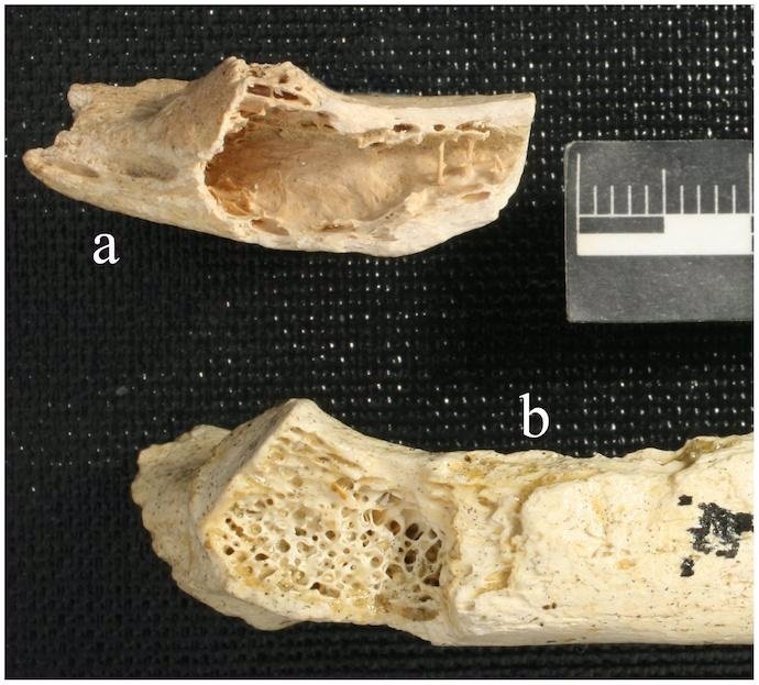 Huesos de neandertal con tumor