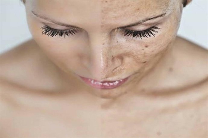 El melasma o manchas en la piel