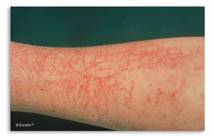 Imagen de una persona con dermatitis atópica