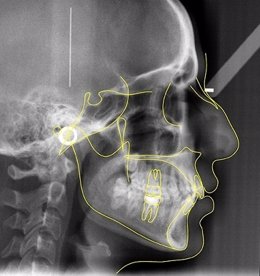 Trazado cefalométrico superpuesto en la Telerradiografía lateral del Cráneo