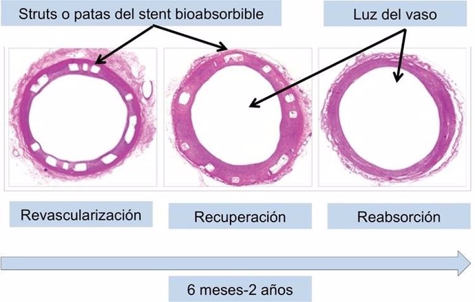 Stents bioabsorbibles