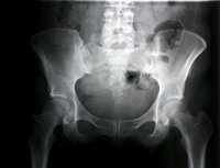 Disminuyen la fracturas de cadera en la población