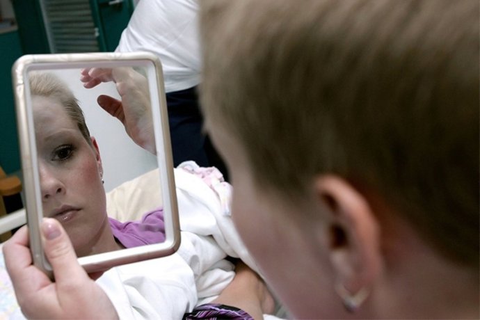 El 10 15% de los pacientes de cáncer TRATADOS quimio  radio no recuperan cabello