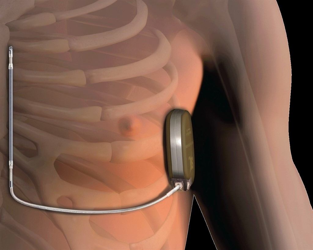 HM Hospitales adquiere el desfibrilador automático implantable