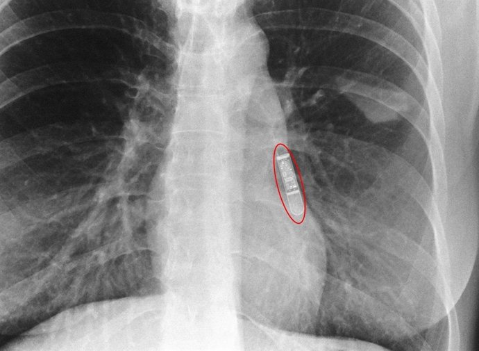 Imagen radiológica tras la implantación. 
