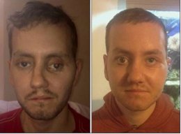 Paciente con reconstrucción del rostro en 3D