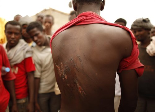Un inmigrante etíope muestras las heridas de las torturas de los traficantes. 