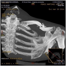 Clavícula Enrique Ponce