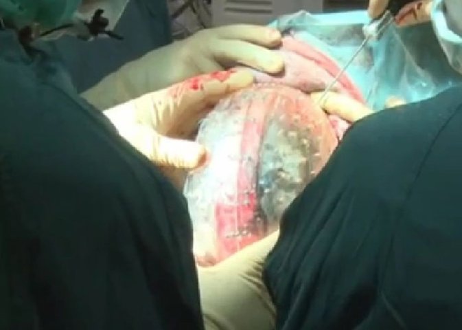 Un cráneo de plástico creado con una impresora 3D salva la vida e una mujer