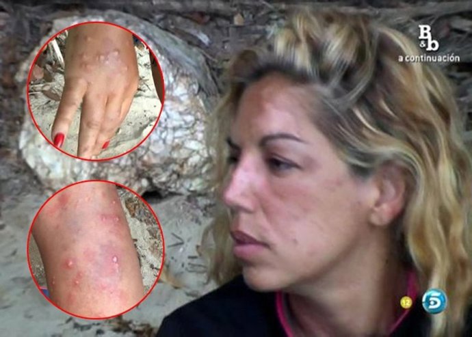 Debate Supervivientes: las picaduras de rebeca