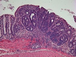 Tumor de colon. Cáncer. 