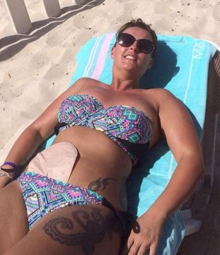 Selfies en bikini con bolsas de colostomía
