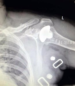 Radiografía del hombro tras la intervención