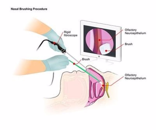 Prueba nasal para la enfermedad priónica humana