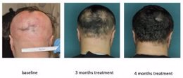 Efectos de un nuevo crecepelo para la alopecia areata
