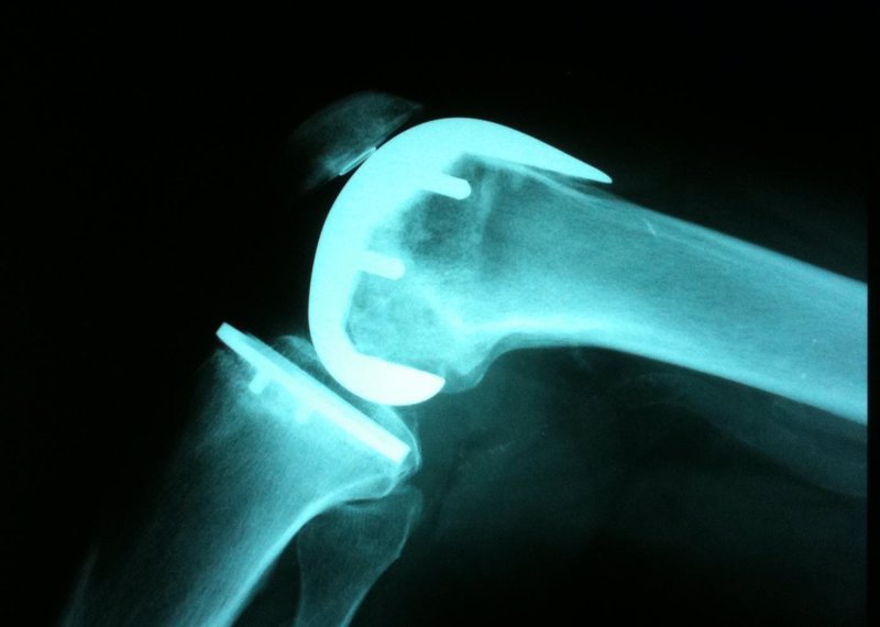 Las prótesis de rodilla pueden ser menos efectivas para las personas