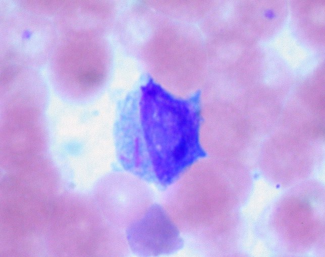 Leucemia mieloide aguda