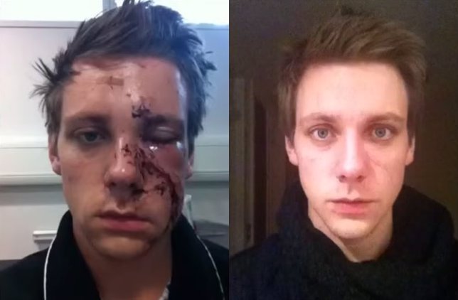 Alan Crowley antes y después de la cirugía plástica