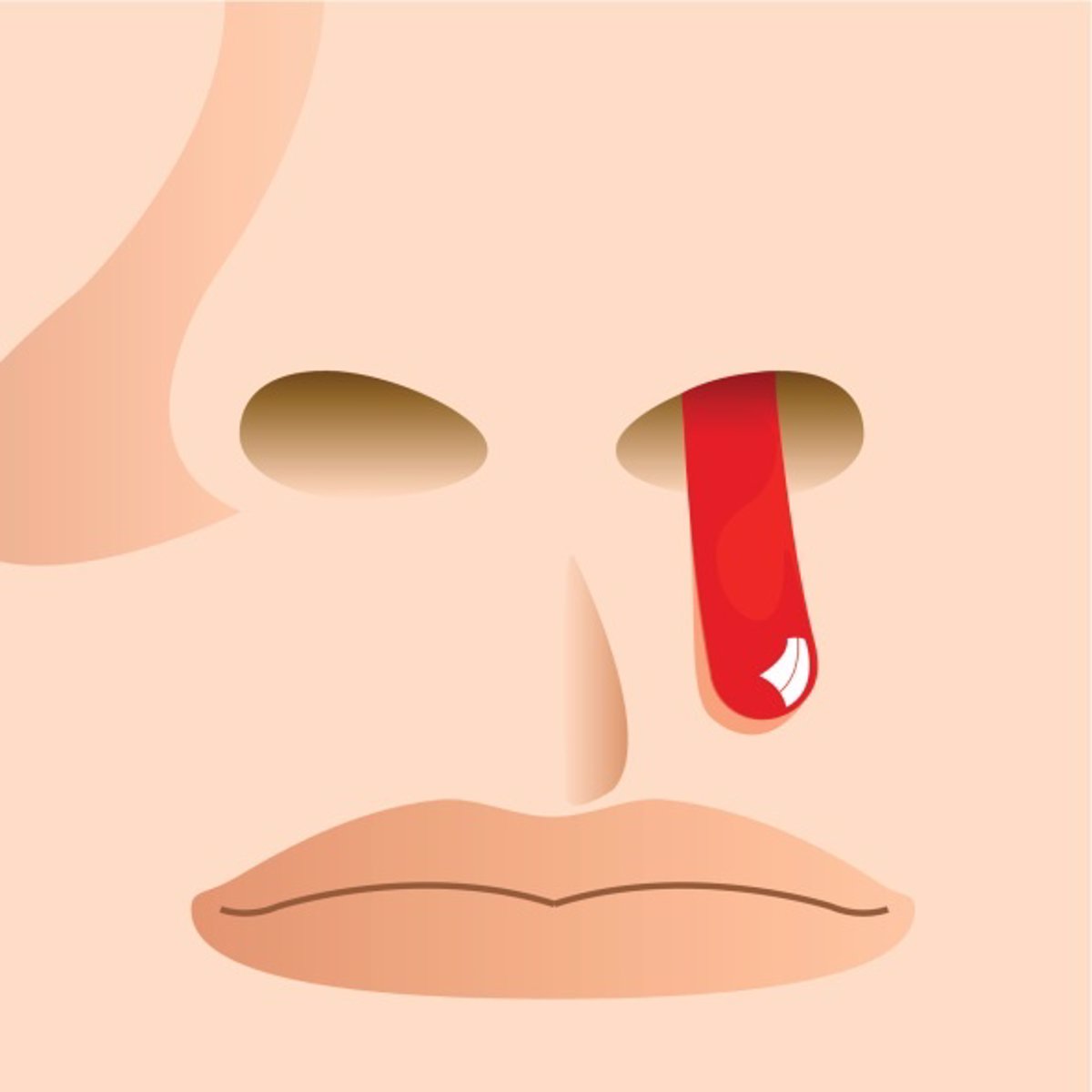 Laboratorio Retener dormitar Hemorragias nasales: ¿banales o graves?