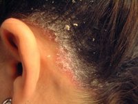 El estigma de la psoriasis