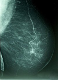 El cáncer de mama es como una "pequeña epidemia" pero, si se detecta a tiempo, puede curarse